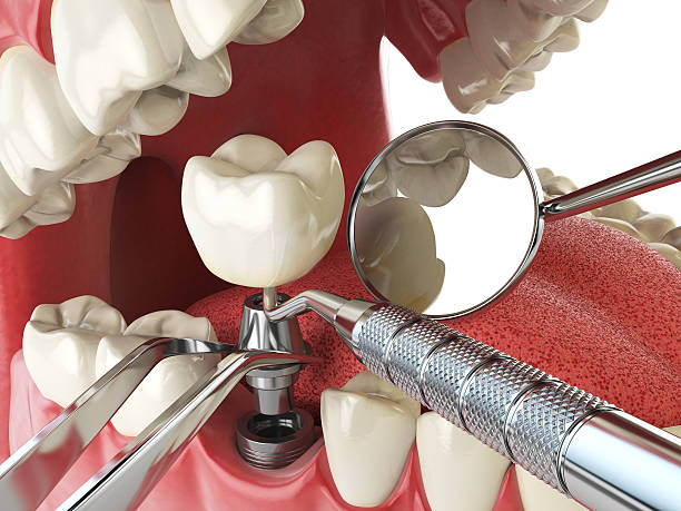 Best Knocked-Out Tooth (Avulsed Tooth) Treatment in Ozona, TX